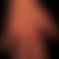 Granuloma anulare: Pronounced knot formation for several years. 54-year-old otherwise healthy wom...