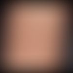 Granuloma anulare:&nbsp;erstmals vor&nbsp;2 Jahren aufgetretene, zentripedal wachsende, anuläre P...