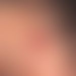 Granuloma eosinophilicum faciei. 2.2 cm large, firm, painless, broadly basal red lump in an 18-ye...