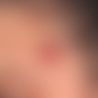 Granuloma eosinophilicum faciei. 2.2 cm large, firm, painless, broadly basal red lump in an 18-ye...