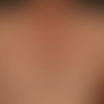 Gynecomastia. Enlargement of the mammae onboth sides in a 67-year-old male patient. No known unde...