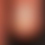 Half and half nail: Zonal, slightly blurred white coloration of the proximal and brown coloration...