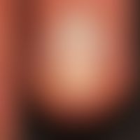 Half and half nail: Zonal, slightly blurred white coloration of the proximal and brown coloration...