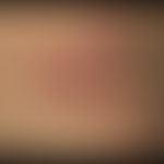 Herpes simplex recidivans: in Abständen von 6-8 Monaten rezidivierender, hier sehr ausgedehnte, m...