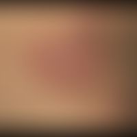 Herpes simplex recidivans: in Abständen von 6-8 Monaten rezidivierender, hier sehr ausgedehnte, m...