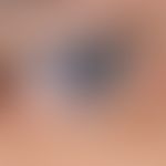 Hidrozystom, apokrines: Lediglich kosmetisch auffällige und störende&nbsp;Blauverfärbung durch fr...