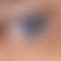 Hidrocystoma, apocrine: Merely cosmetically noticeable and disturbing blue discoloration due to p...