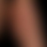 Hyperpigmentation caloric: Net-like hyperpigmentation caused by regular application of heat. No c...