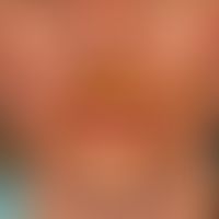 Impetigo contagiosa : Massiver pyodermisierter Herpes simplex der Gesichtshaut mit Bläschen, Pust...