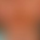 Impetigo contagiosa: Massive Pyodermie der Gesichtshaut.
