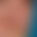 Ekkrine Hidrozystome: Kleine wasserklare Bläschen an der Nase. Deutlich stärkeres Heraustreten be...