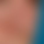 Ekkrine Hidrozystome: Kleine wasserklare Bläschen an der Nase. Deutlich stärkeres Heraustreten be...