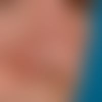 Eccrine Hidrocystoma: Small water clear vesicles on the nose. Significantly more prominent when s...