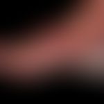 Hand-foot syndrome: after chemotherapy. grade 3: extensive blistering; oozing, coarse lamellar de...