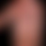 Hand-foot syndrome: after chemotherapy. grade 3: extensive blistering; oozing, coarse lamellar de...