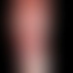 Hand-foot syndrome: after combined chemotherapy. grade 3: extensive blistering; oozing, coarse la...