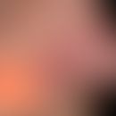 Knotiges Basalzelllkarzinom: relativ unscheinbares, nicht-symptomatisches,&nbsp;rotes Knötchen mi...