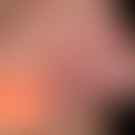 Nodular or nodular basal cell carcinoma. Relatively inconspicuous, non-symptomatic, red nodule wi...