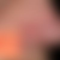 Knotiges Basalzelllkarzinom: relativ unscheinbares, nicht-symptomatisches,&nbsp;rotes Knötchen mi...