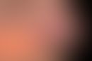Knotiges Basalzelllkarzinom: relativ unscheinbares, nicht-symptomatisches,&nbsp;rotes Knötchen mi...