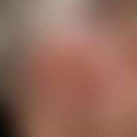 Komplikatives Basalzellkarzinom mit kompletter Zerstörung der Ohrmuschel und des äußeren Gehörgan...