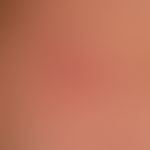 Urticaria pigmentosa: Darier sign
