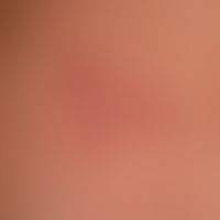 Urticaria pigmentosa: Darier sign
