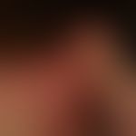 Airborne Contact Dermatitis: Retroaurikulärer Befall. Dieses Muster&nbsp;unterscheidet die ACD vo...
