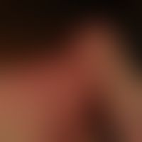 Airborne Contact Dermatitis: Retroaurikulärer Befall. Dieses Muster&nbsp;unterscheidet die ACD vo...