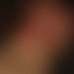 Airborne&nbsp;Contact Dermatitis: Akute,massiv&nbsp;juckende und brennende Dermatitis, die auf di...