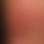 Erysipelas, acute: Acute reddened and painful, large-area, succulent plaque, only blurredly limit...