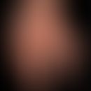 Gichttophi: Massiver Befall der Finger.&nbsp;
