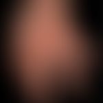 Gichttophi: Massiver Befall der Finger.&nbsp;

