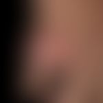 Gichttophi: Detailaufnahme.
