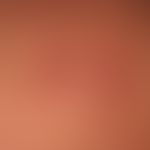 Keloide: Flache, oberflächenglatte, feste, rote Knoten. Vermehrte Gefäßzeichnung. Bei diesem Kran...