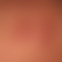 Keloide: Flache, oberflächenglatte, feste, rote Knoten. Vermehrte Gefäßzeichnung. Bei diesem Kran...