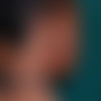 Keloid node. Chronic stationary clinical picture. Gigantic keloid node due to repeated ritual inj...