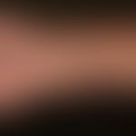 Keratosis lichenoides chronica:Lichen-planus-artiges Krankheitsbild mit flächigen lichenoiden Pla...