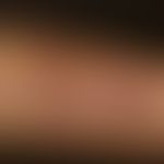 Keratosis lichenoides chronica:Unterarm mit flächigen zerkratzten rötllich lividen Plaques.
