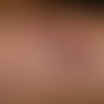 Keratosis lichenoides chronica: Detailaussschnitt
