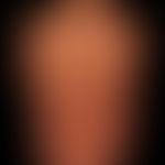 Kaposi's sarcoma epidemic: Dissemination of the angiosarcoma in the skin. Characteristic arrangem...