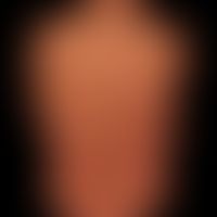 Kaposi's sarcoma epidemic: Dissemination of the angiosarcoma in the skin. Characteristic arrangem...