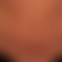 Kaposi-Sarkom endemisches: Detailaufnahme mit disseminierten Plaques
