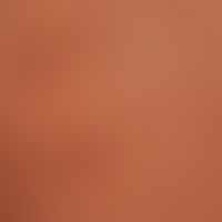 Kaposi's sarcoma endemic: Detailed picture with arrangement of the sarcomas in the tension lines ...