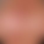 Karzinom&nbsp; kutanes&nbsp;(Carcinoma in situ vom Typ der aktinischen Keratosen) 1a Keratosen) m...