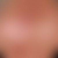Karzinom&nbsp; kutanes&nbsp;(Carcinoma in situ vom Typ der aktinischen Keratosen) 1a Keratosen) m...