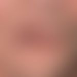 Lip carcinoma: A firm, painless, broad-based nodule with a central honeycomb plug, apparently ori...