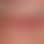 Carcinoma of the lips : Wide, firm, painless, warty, eroded and ulcerated plaque of the lower lip...