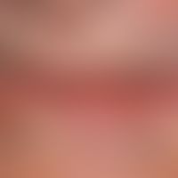 Carcinoma of the lips : Wide, firm, painless, warty, eroded and ulcerated plaque of the lower lip...
