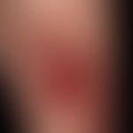 Squamous cell carcinoma of the skin: ulcerated, spinocellular carcinoma of the lower leg, which h...